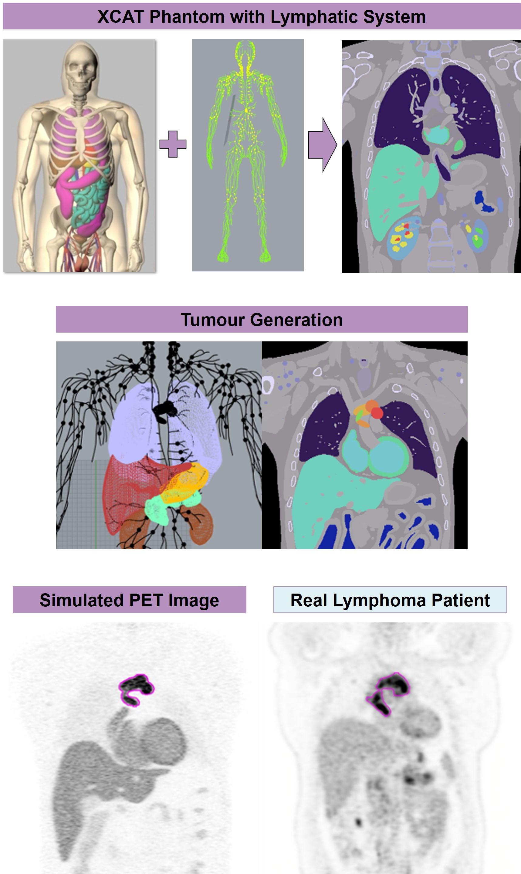 Lymphatic System Added to the 4D XCAT Phantom