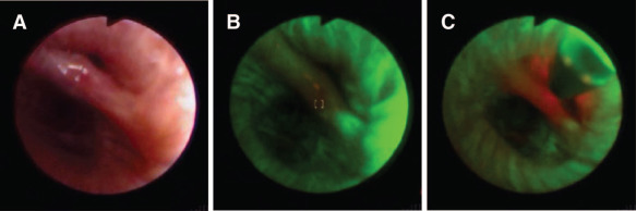 Raman Spectroscopy and Multimodality Endoscopy Imaging 1